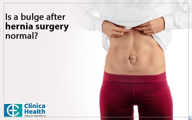 Is a bulge after hernia surgery normal? - ClinicaHealth