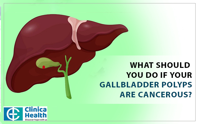 Things you must do if you have cancerous gallbladder polyps.