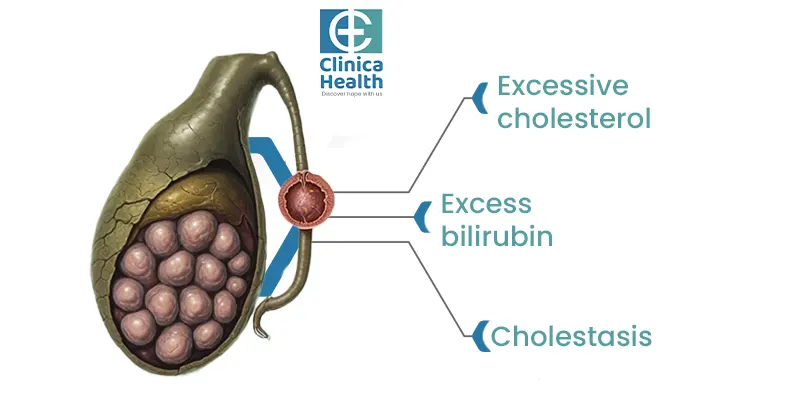 Factors that can causes gallbladder stones  