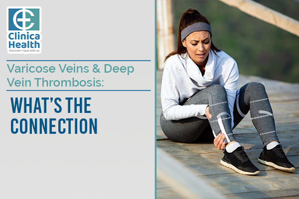 Varicose veins and Deep vein thrombosis: What’s the connection