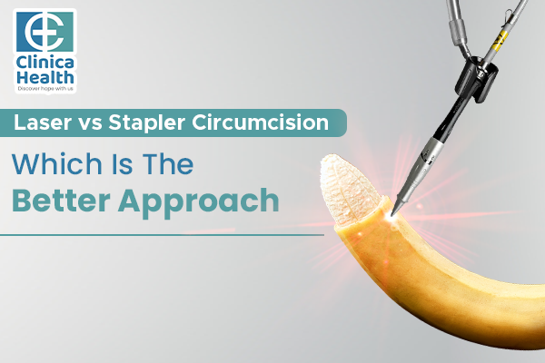 Laser vs. stapler circumcision Which is the better approach