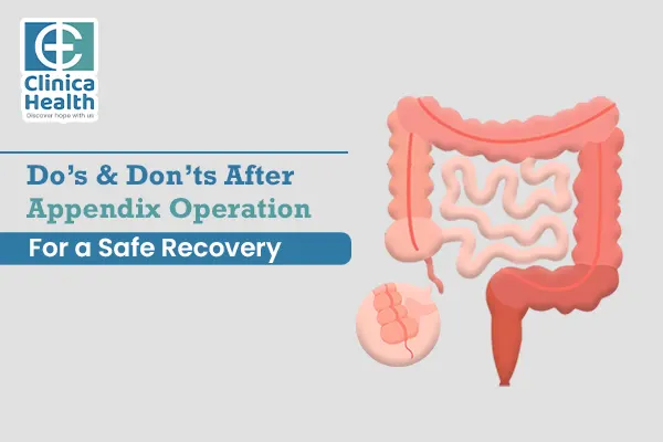 Dos And Don’ts After Appendix Operation For A Safe Recovery