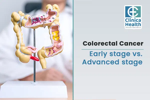 Colorectal Cancer Early Vs Advanced Stage