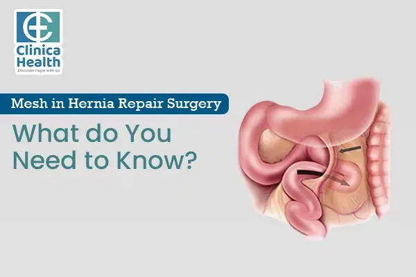 Mesh in hernia repair surgery What do you need to know